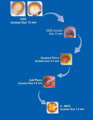 oculoplasty