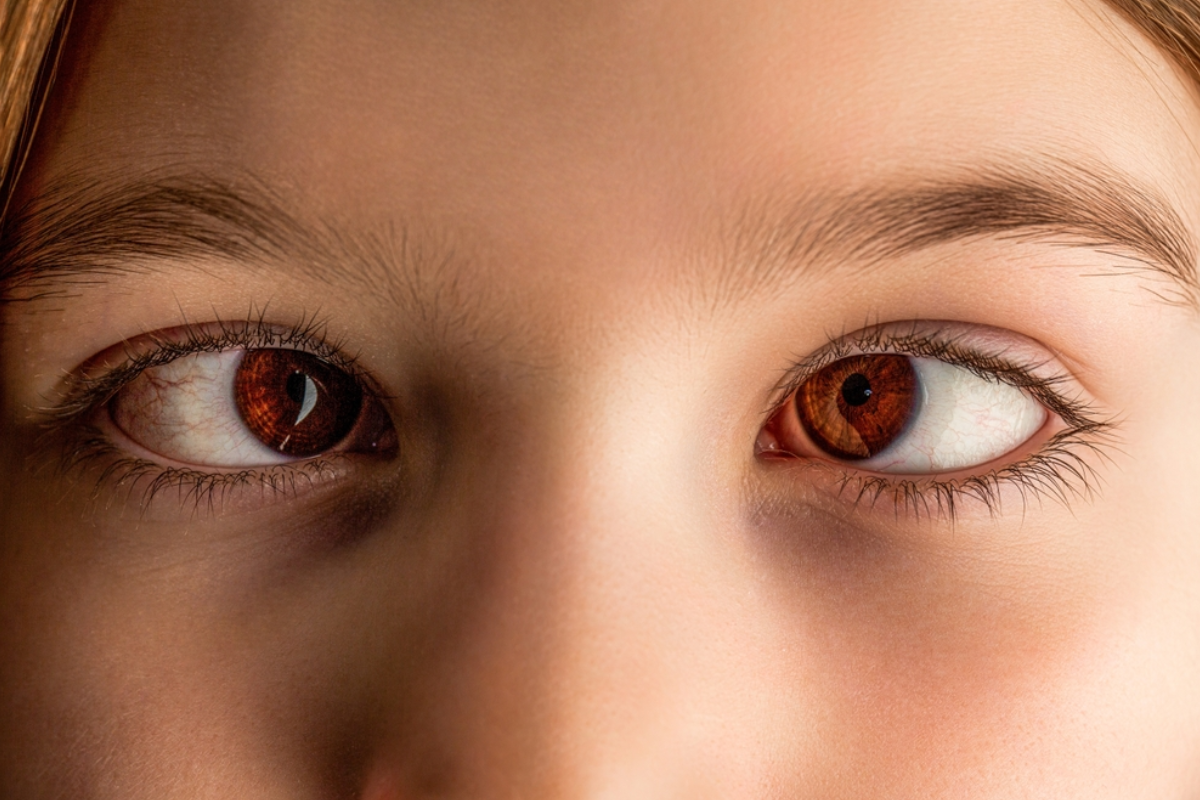 strabismus