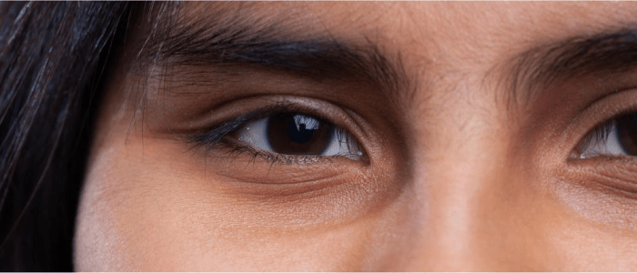 keratoconus